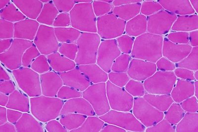 Mice with Facioscapulohumeral Muscular Dystrophy show completely normal muscle fibers after treatment with a targeted gene therapy.